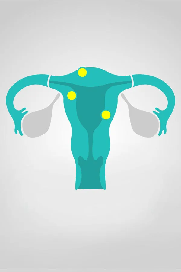 Fibroids-Treatment Illustration of a uterus with yellow dots indicating fibroids. Get treatment for fibroids from Healthy Aging Medical Centers of New Jersey in Northern New Jersey.
